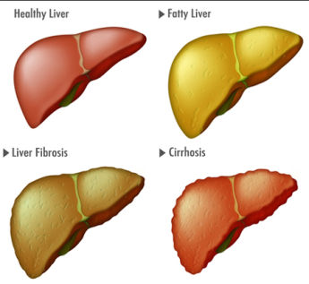 penyakit liver