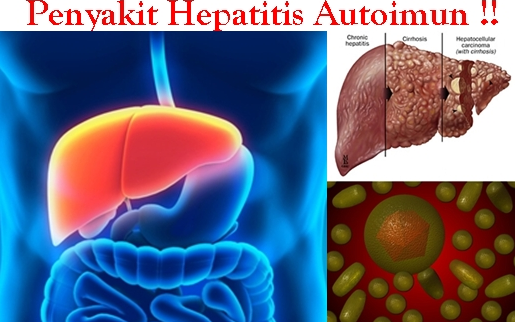 hepatitis autoimun